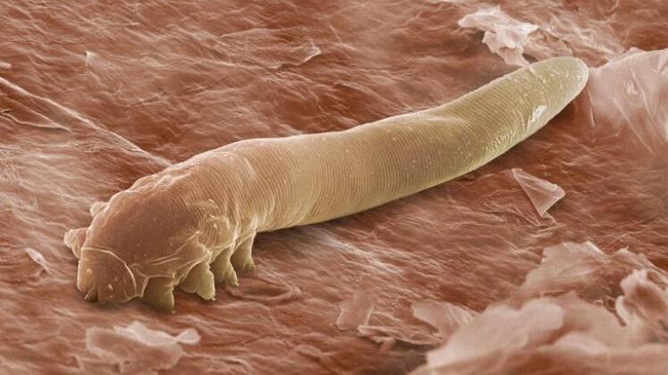 červ, který žije pod lidskou kůží
