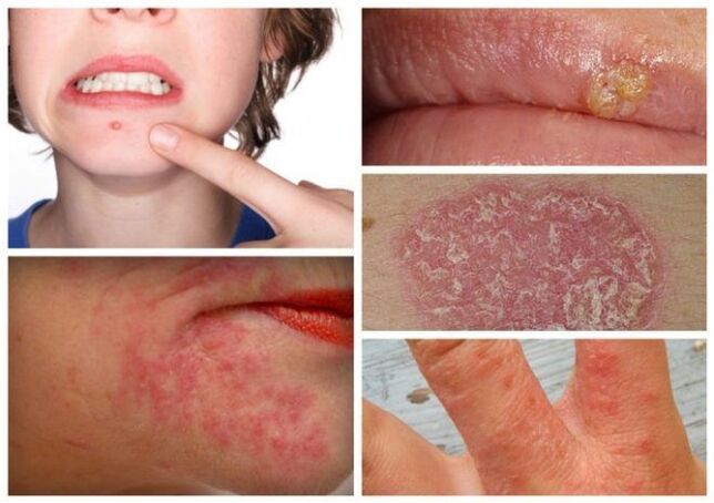 Alergie a kožní onemocnění jsou příznaky parazitů v těle