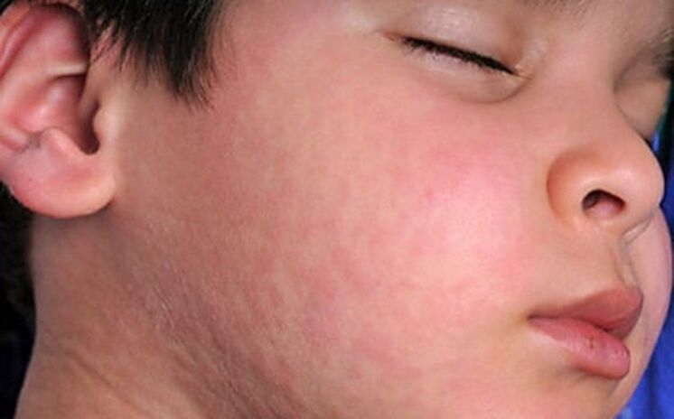 Alergické vyrážky na kůži - příznak přítomnosti parazitických červů v těle